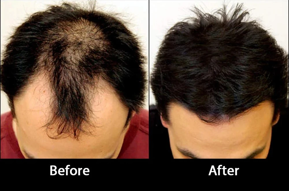 Hair Replacement