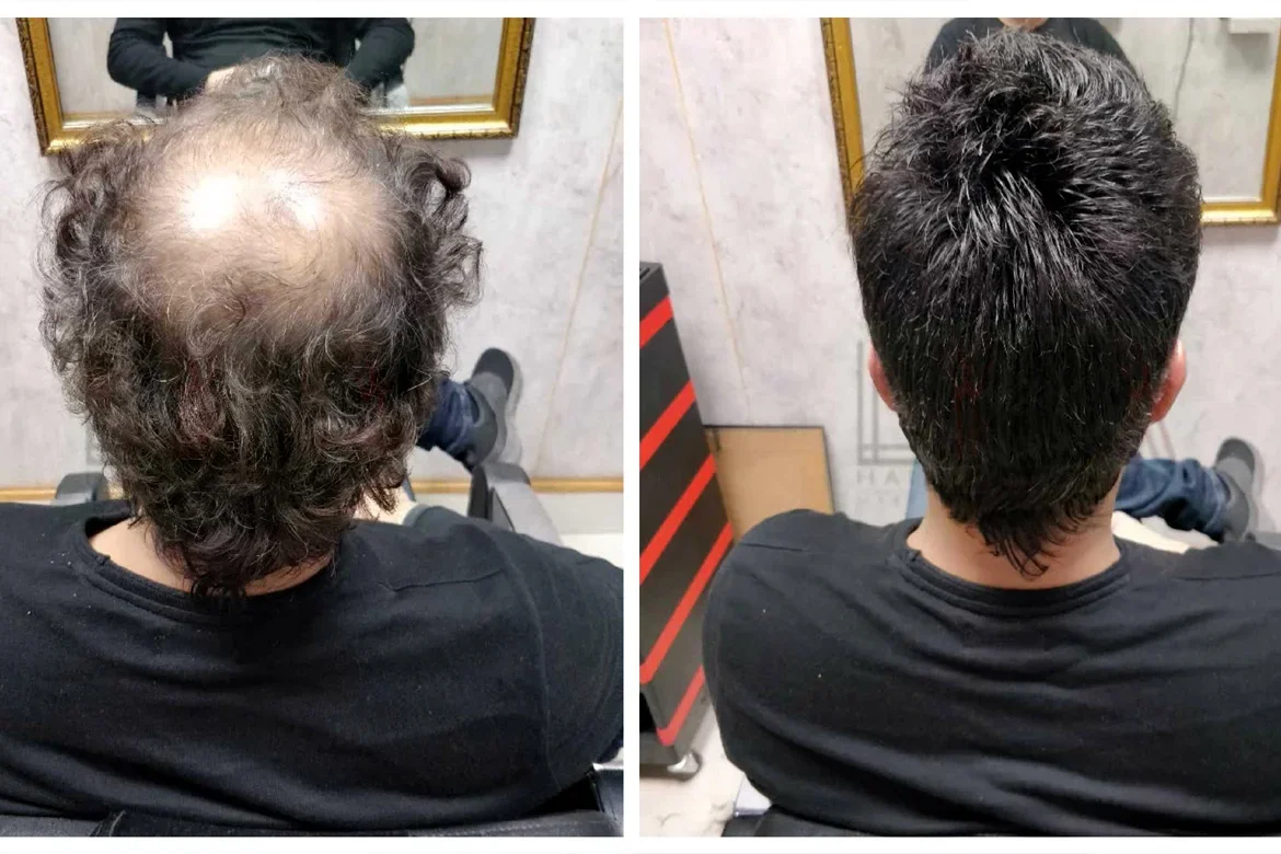 Hair Replacement