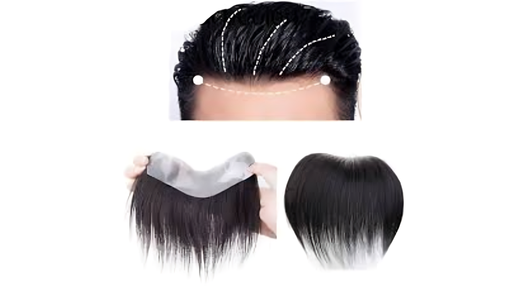 Front Line Hair Patch Hyderabad by B The Best Hair Studio