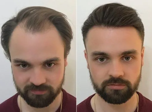 Hair Patches