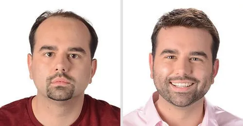 Before and After Hair Patch Hyderabad